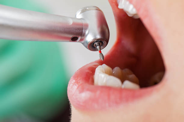 Best Emergency Root Canal Therapy in Essex, IL